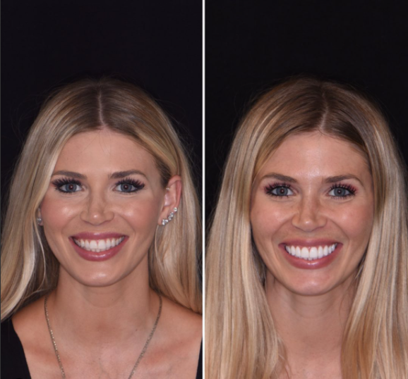 After smile makeover Istanbul - transformation