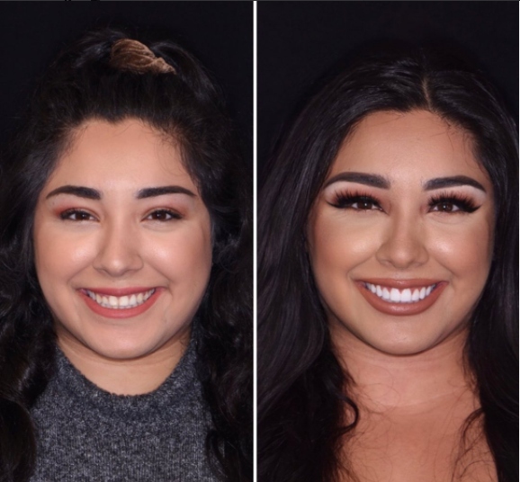 Before smile makeover Istanbul